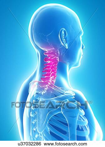Neck pain, conceptual artwork View Large Illustration Stock Illustration - Neck pain, conceptual artwork. Fotosearch