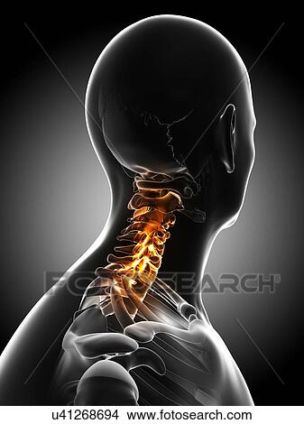 Stock Illustration - Neck pain, conceptual artwork. Fotosearch