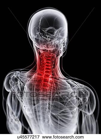 Neck pain, conceptual artwork View Large Illustration Stock Illustration - Neck pain, conceptual artwork. Fotosearch