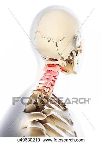 Neck pain, conceptual artwork View Large Illustration Stock Illustration - Neck pain, conceptual artwork. Fotosearch