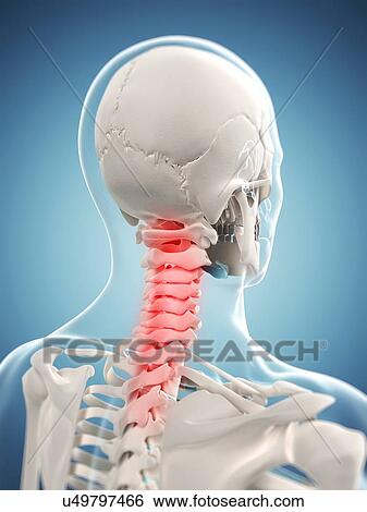 Neck pain, conceptual artwork View Large Illustration Stock Illustration - Neck pain, conceptual artwork. Fotosearch
