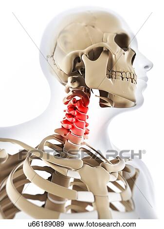 Stock Illustration - Neck pain, conceptual artwork. Fotosearch