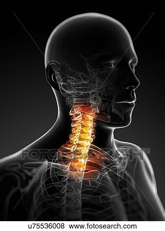 Neck pain, conceptual artwork View Large Illustration Stock Illustration - Neck pain, conceptual artwork. Fotosearch