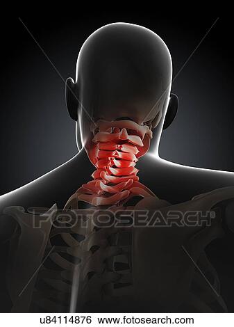 Neck pain, conceptual artwork View Large Illustration Stock Illustration - Neck pain, conceptual artwork. Fotosearch