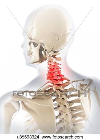 Neck pain, conceptual artwork View Large Illustration Stock Illustration - Neck pain, conceptual artwork. Fotosearch