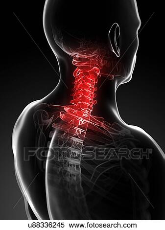 Stock Illustration - Neck pain, conceptual artwork. Fotosearch