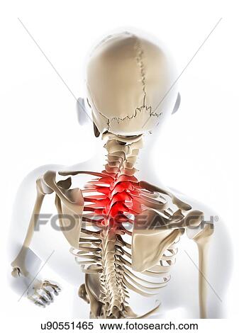 Neck pain, conceptual artwork View Large Illustration Stock Illustration - Neck pain, conceptual artwork. Fotosearch