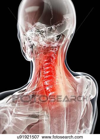 Stock Illustration - Neck pain, conceptual artwork. Fotosearch