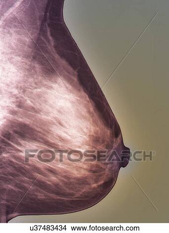 Stock Illustration - Normal mammogram. Fotosearch