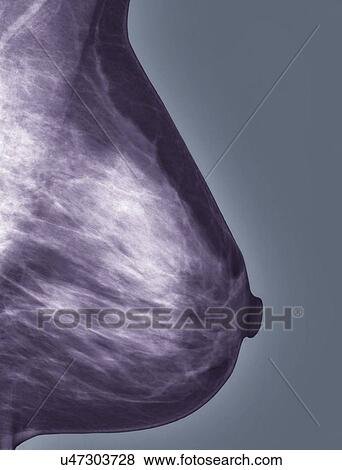Normal mammogram View Large Illustration Stock Illustration - Normal mammogram. Fotosearch