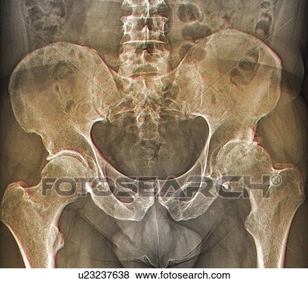 Stock Illustration - Osteoarthritis of the hip, X-ray. Fotosearch
