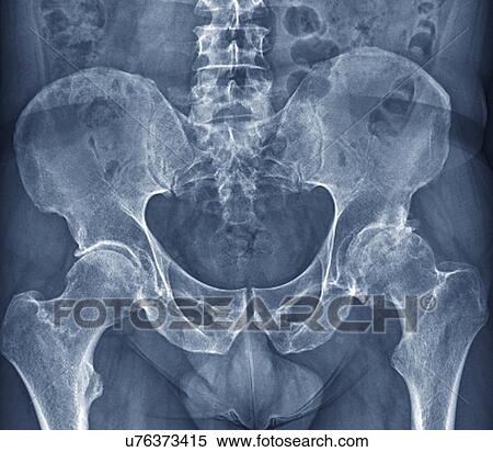Stock Illustration - Osteoarthritis of the hip, X-ray. Fotosearch