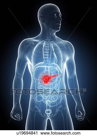 Pancreatic cancer, artwork View Large Illustration Clip Art - Pancreatic cancer, artwork. Fotosearch