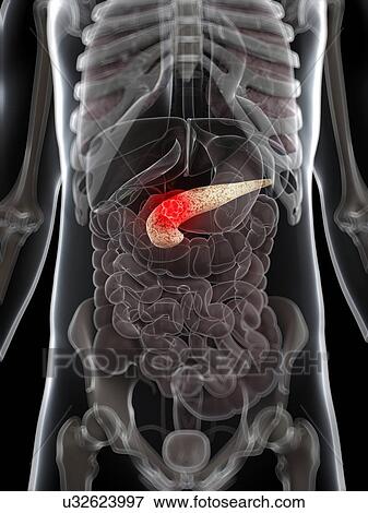 Pancreatic cancer, artwork View Large Illustration Stock Illustration - Pancreatic cancer, artwork. Fotosearch