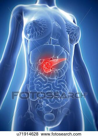 Pancreatic cancer, artwork View Large Illustration Stock Illustration - Pancreatic cancer, artwork. Fotosearch