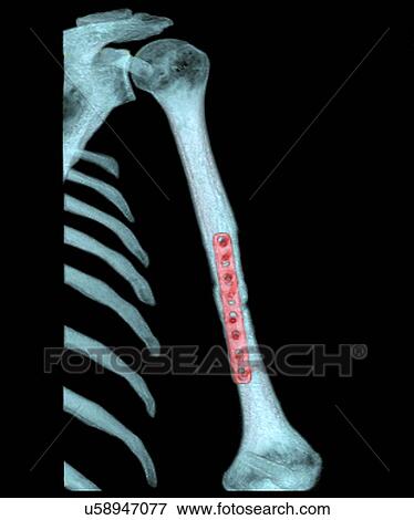 Stock Illustration - Pinned arm fracture, 3D CT scan. Fotosearch