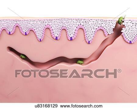 Scabies mites, artwork View Large Illustration Stock Illustration - Scabies mites, artwork. Fotosearch