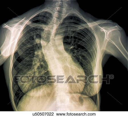 Drawing - Scoliosis of the spine, X-ray. Fotosearch