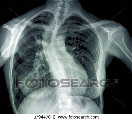 Drawing - Scoliosis of the spine, X-ray. Fotosearch