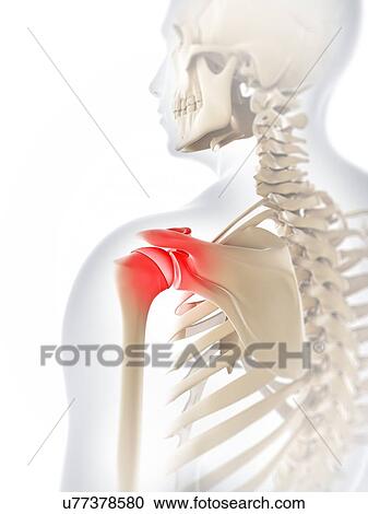 Clipart - Shoulder pain, conceptual artwork. Fotosearch