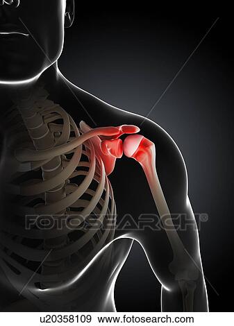 Stock Illustration - Shoulder pain, conceptual artwork. Fotosearch