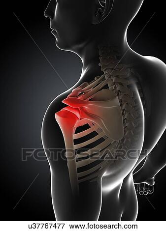 Shoulder pain, conceptual artwork View Large Illustration Stock Illustration - Shoulder pain, conceptual artwork. Fotosearch