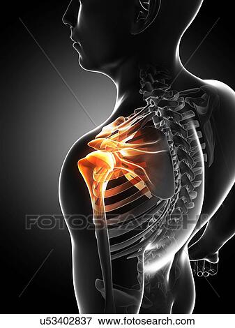 Stock Illustration - Shoulder pain, conceptual artwork. Fotosearch