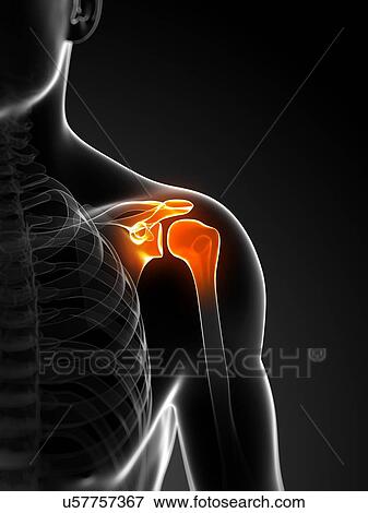 Stock Illustration - Shoulder pain, conceptual artwork. Fotosearch