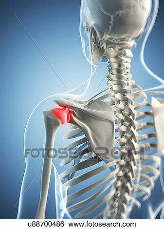 Stock Illustration - Shoulder pain, conceptual artwork. Fotosearch