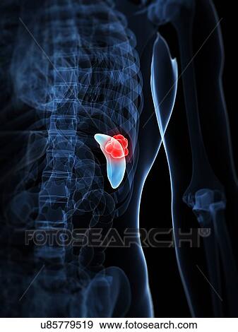 Spleen cancer, artwork View Large Illustration Stock Illustration - Spleen cancer, artwork. Fotosearch