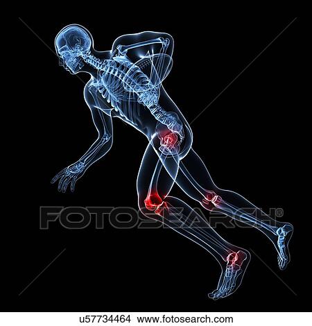 Sports injuries, conceptual artwork View Large Illustration Stock Illustration - Sports injuries, conceptual artwork. Fotosearch