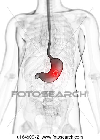 Stomach cancer, artwork View Large Illustration Drawing - Stomach cancer, artwork. Fotosearch