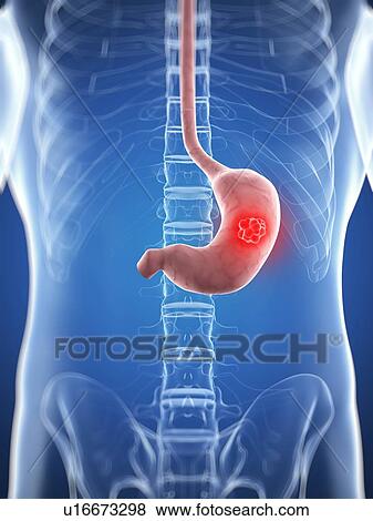 Stomach cancer, artwork View Large Illustration Stock Illustration - Stomach cancer, artwork. Fotosearch