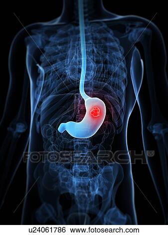 Stomach cancer, artwork View Large Illustration Stock Illustration - Stomach cancer, artwork. Fotosearch