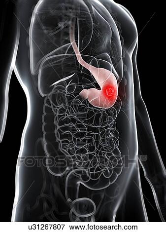 Stomach cancer, artwork View Large Illustration Stock Illustration - Stomach cancer, artwork. Fotosearch