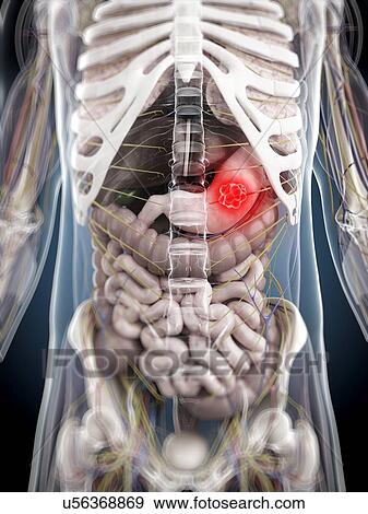 Stomach cancer, artwork View Large Illustration Stock Illustration - Stomach cancer, artwork. Fotosearch