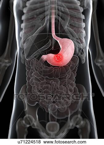 Stomach cancer, artwork View Large Illustration Stock Illustration - Stomach cancer, artwork. Fotosearch
