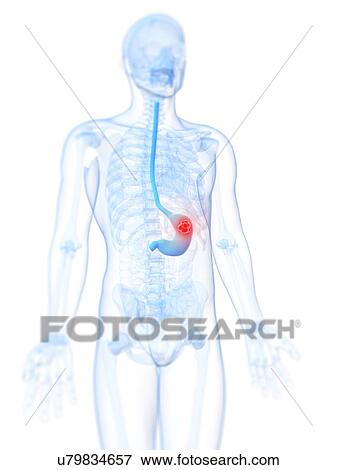Stock Illustration - Stomach cancer, artwork. Fotosearch