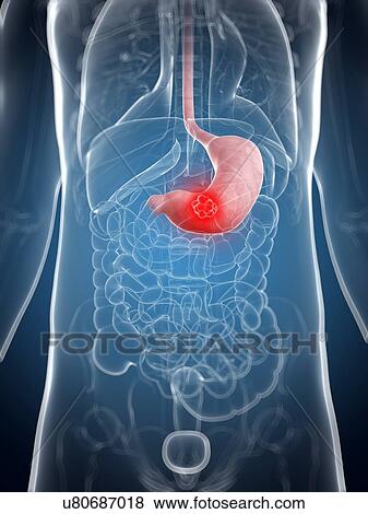 Stock Illustration - Stomach cancer, artwork. Fotosearch