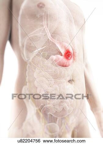 Stomach cancer, artwork View Large Illustration Stock Illustration - Stomach cancer, artwork. Fotosearch