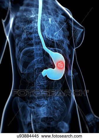 Stomach cancer, artwork View Large Illustration Stock Illustration - Stomach cancer, artwork. Fotosearch