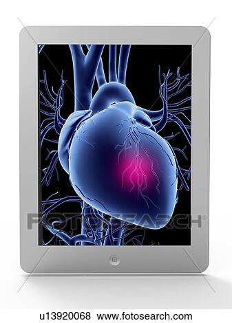 Tablet computer, heart attack artwork View Large Illustration Stock Illustration - Tablet computer, heart attack artwork. Fotosearch