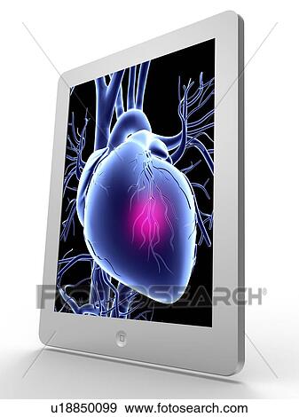 Tablet computer, heart attack artwork View Large Illustration Stock Illustration - Tablet computer, heart attack artwork. Fotosearch