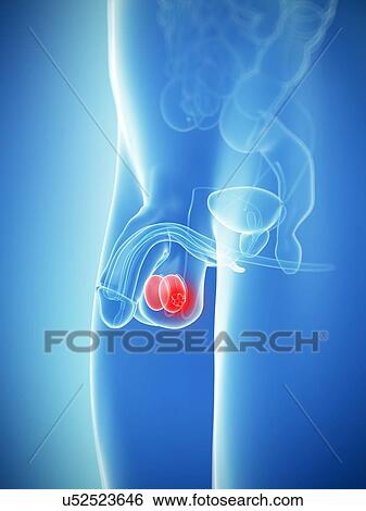 Testicular cancer, artwork View Large Illustration Stock Illustration - Testicular cancer, artwork. Fotosearch