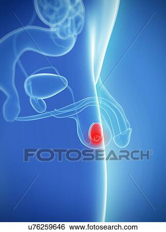 Testicular cancer, artwork View Large Illustration Stock Illustration - Testicular cancer, artwork. Fotosearch