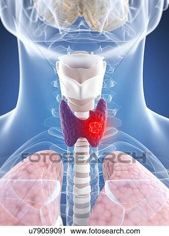 Thyroid cancer, artwork View Large Illustration Clip Art - Thyroid cancer, artwork. Fotosearch