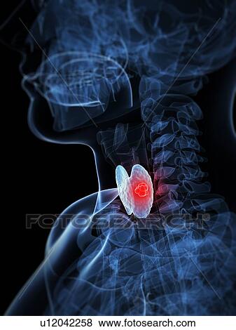 Thyroid cancer, artwork View Large Illustration Stock Illustration - Thyroid cancer, artwork. Fotosearch