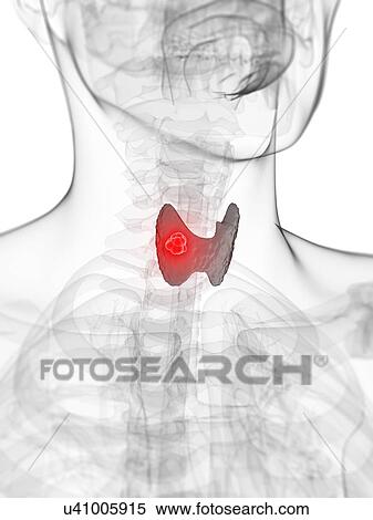Thyroid cancer, artwork View Large Illustration Stock Illustration - Thyroid cancer, artwork. Fotosearch