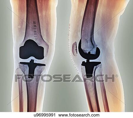 Total knee replacement, X-rays View Large Illustration Clip Art - Total knee replacement, X-rays. Fotosearch