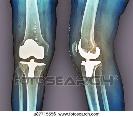 Total knee replacement, X-rays View Large Illustration Stock Illustration - Total knee replacement, X-rays. Fotosearch